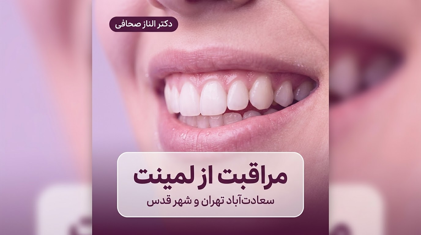 عمر لمینت دندان و مراقبت‌های پس از آن؛ راهنمای ساکنان سعادت‌آباد تهران و شهر قدس